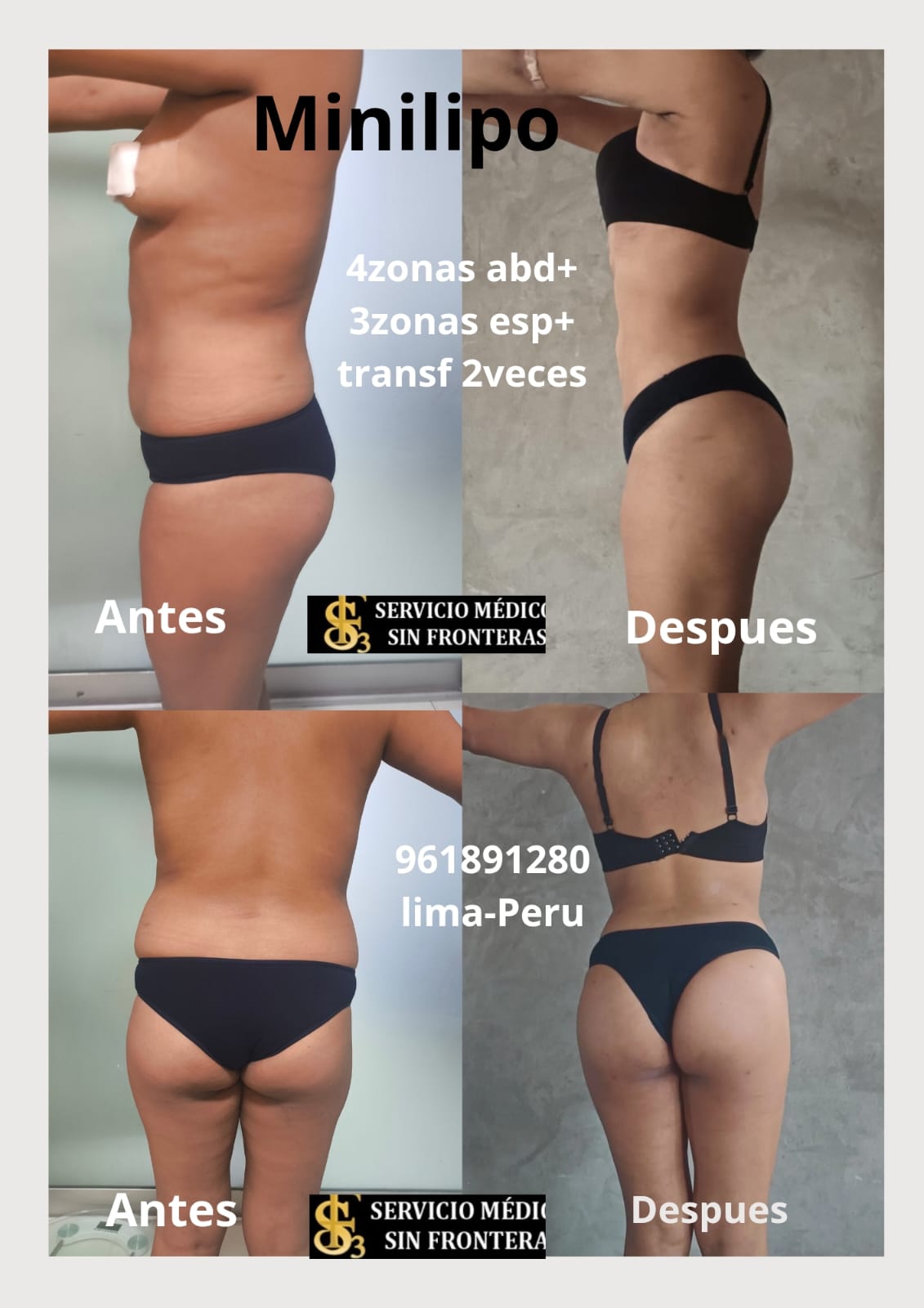 Resultado Lipo 360 2